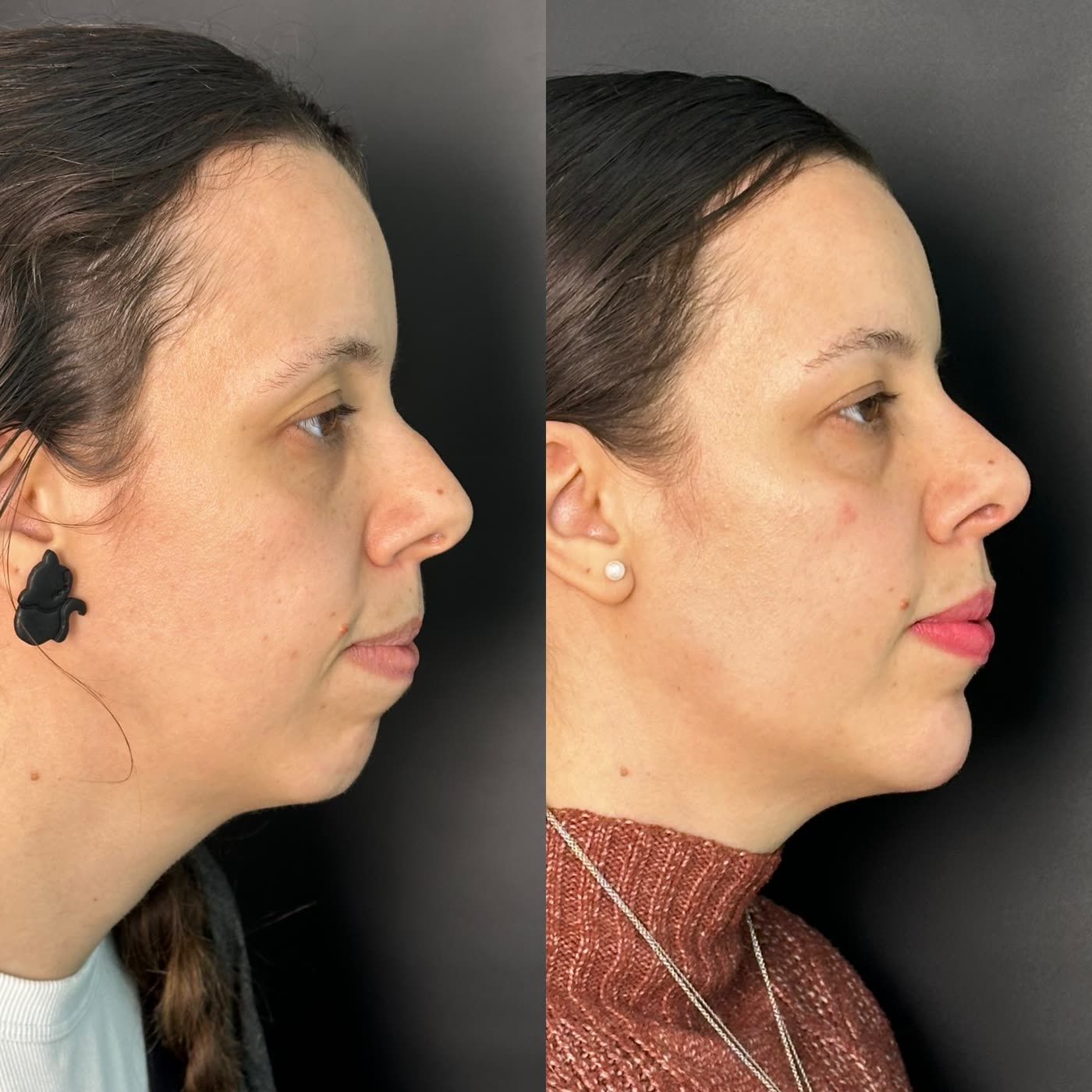 Resultado 1 de harmonização facial — antes e depois, perfil (queixo e mandíbula)