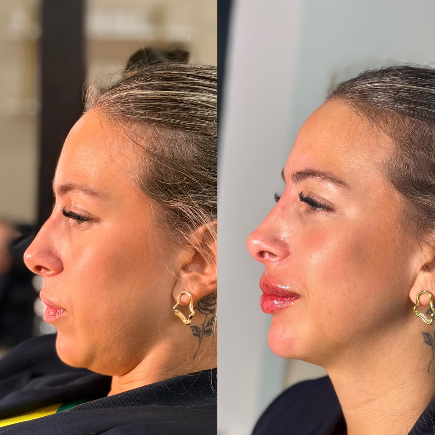 Resultado 2 de harmonização facial — antes e depois, perfil (lábios e nariz)