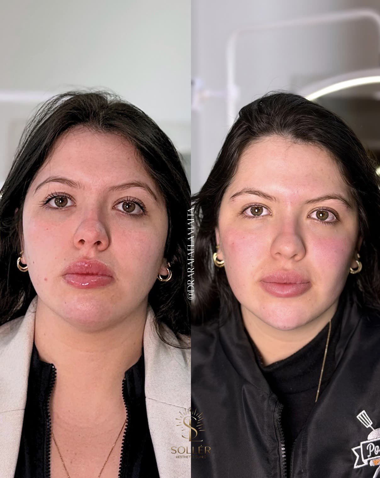 Resultado 3 de harmonização facial — antes e depois, vista frontal