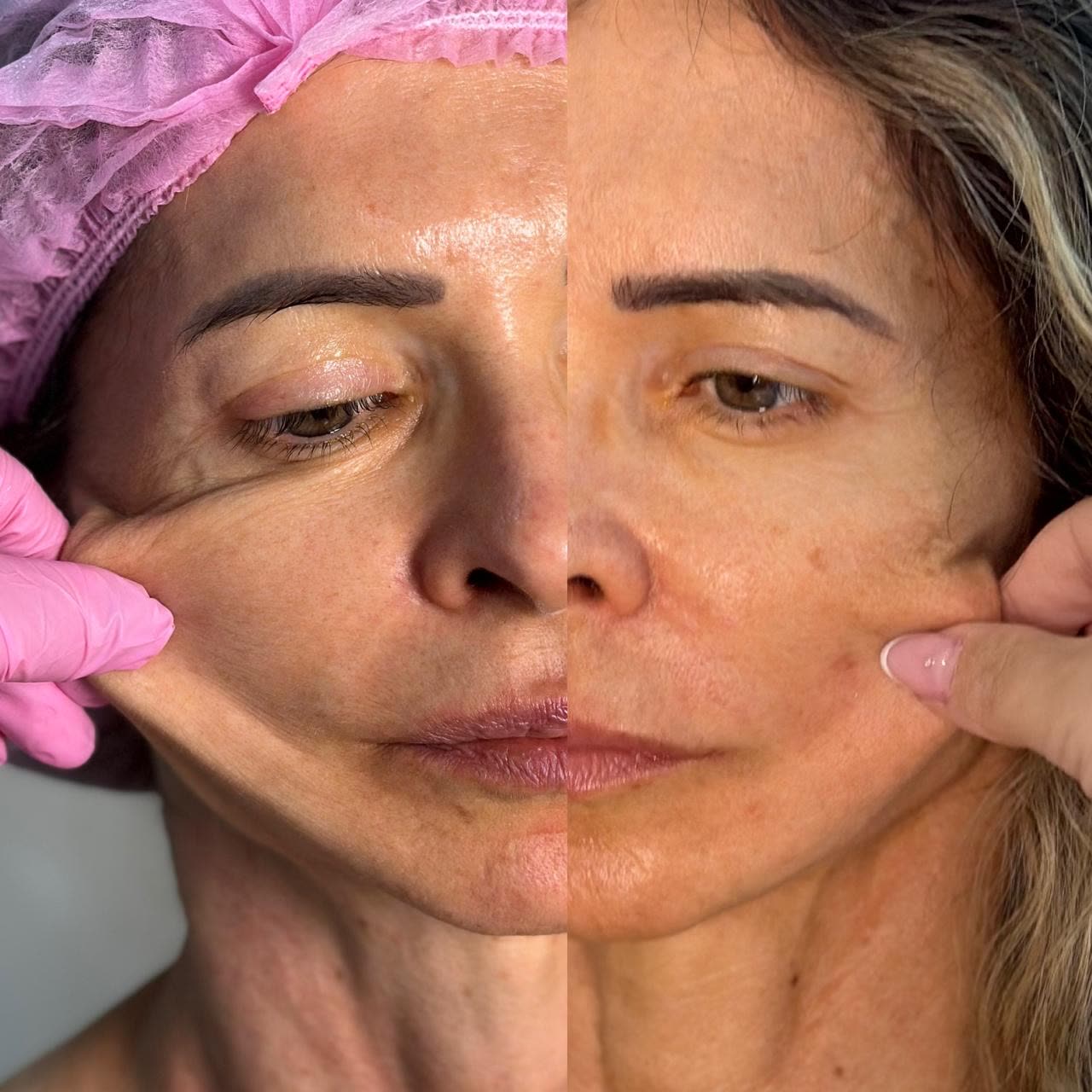 Resultado 4 de harmonização facial — antes e depois, rosto dividido ao meio