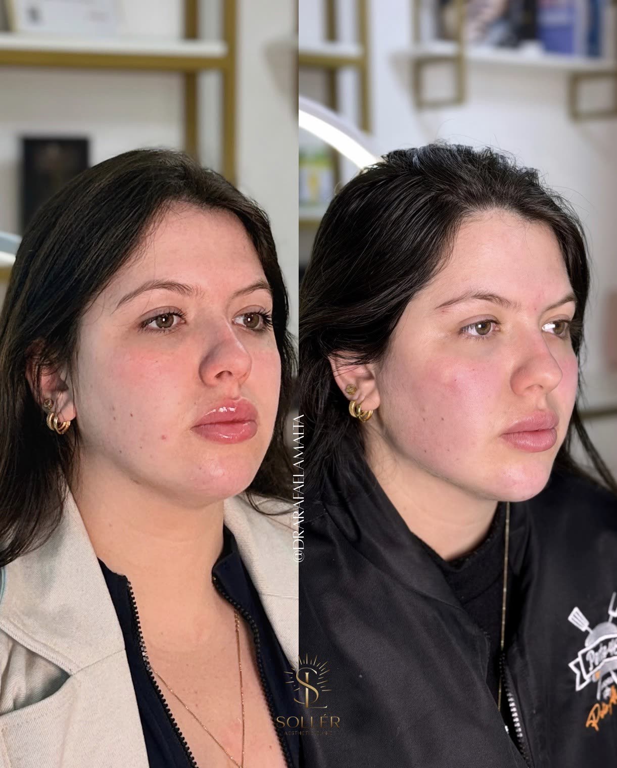 Resultado 5 de harmonização facial — antes e depois, vista frontal angulada