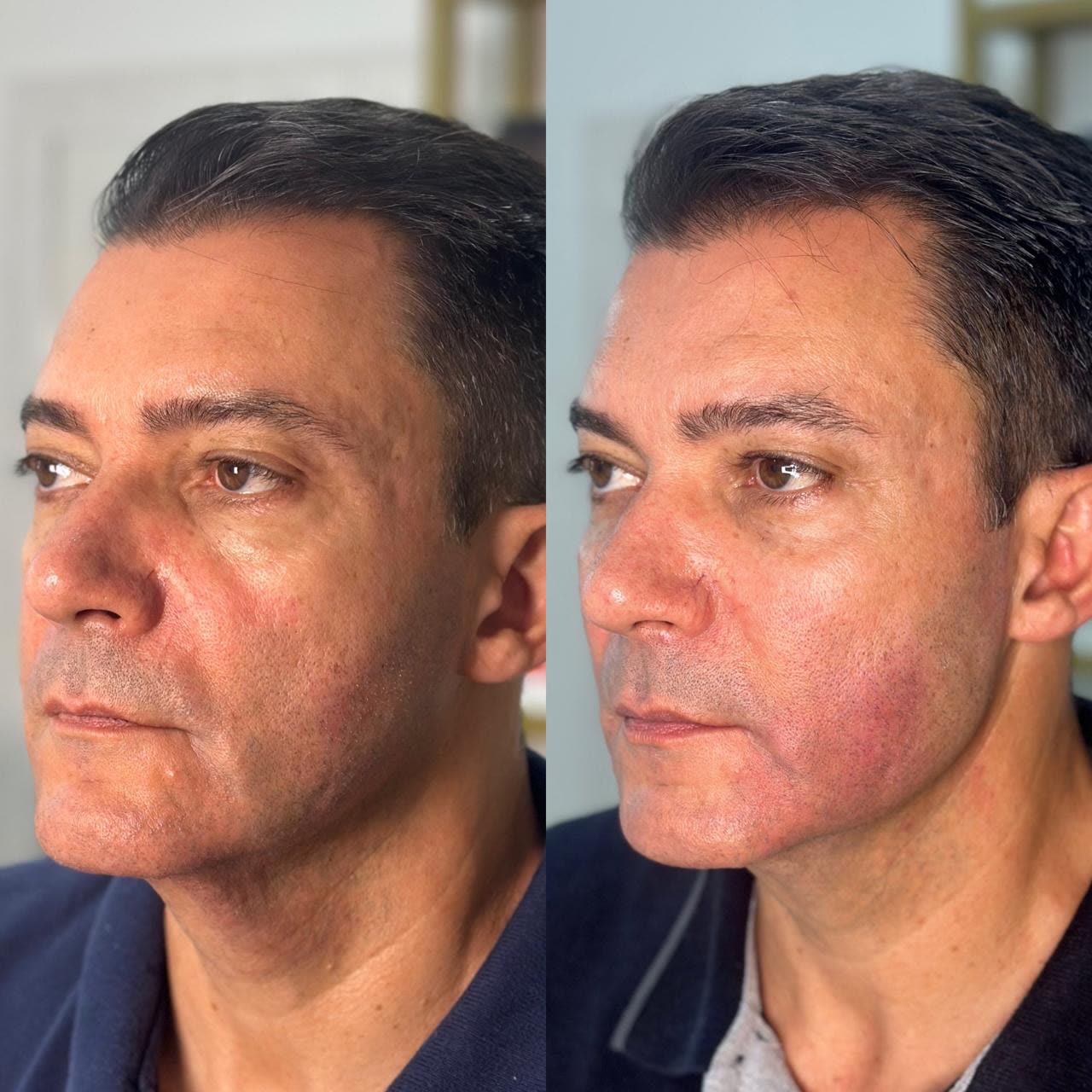 Resultado 6 de harmonização facial — antes e depois, paciente masculino, perfil