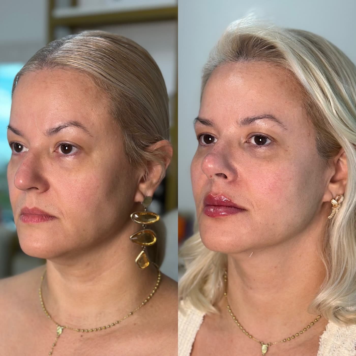Resultado 7 de harmonização facial — antes e depois, perfil