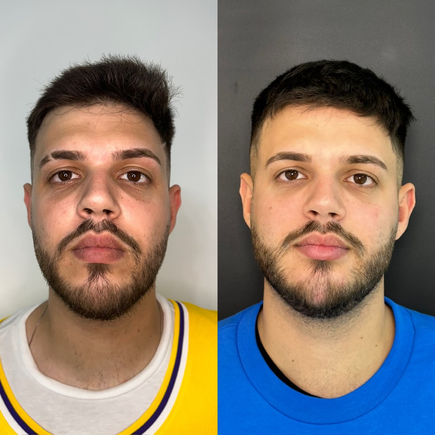 Resultado 8 de harmonização facial — antes e depois, paciente masculino, vista frontal