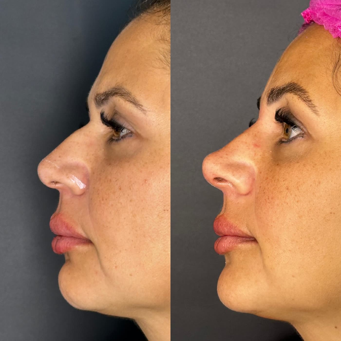 Resultado 9 de harmonização facial — antes e depois, perfil