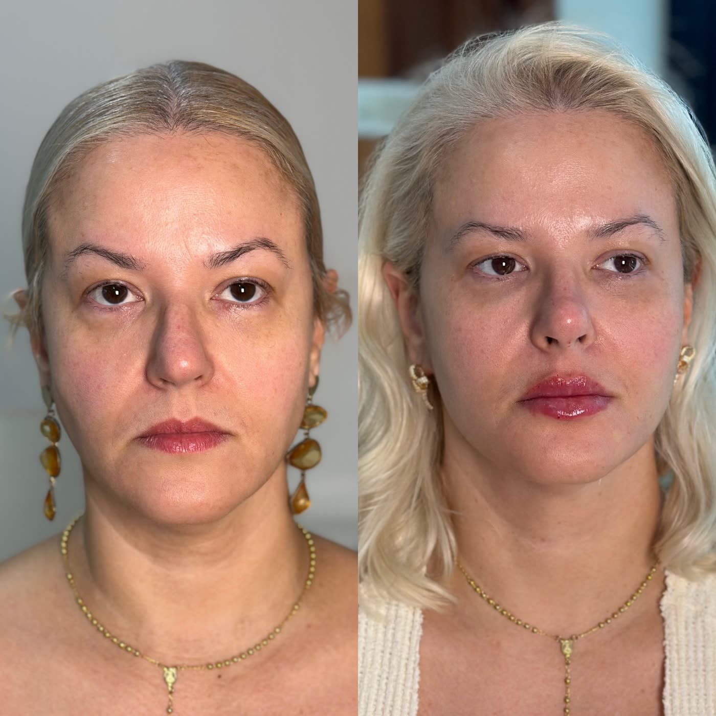 Resultado 10 de harmonização facial — antes e depois, vista frontal