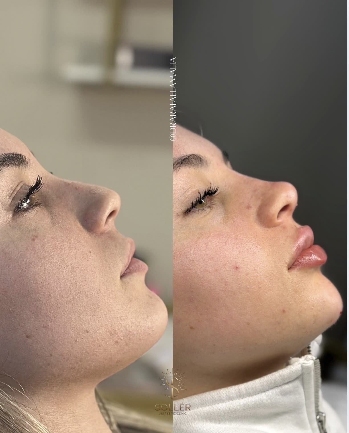 Resultado 11 de harmonização facial — antes e depois, perfil, queixo elevado