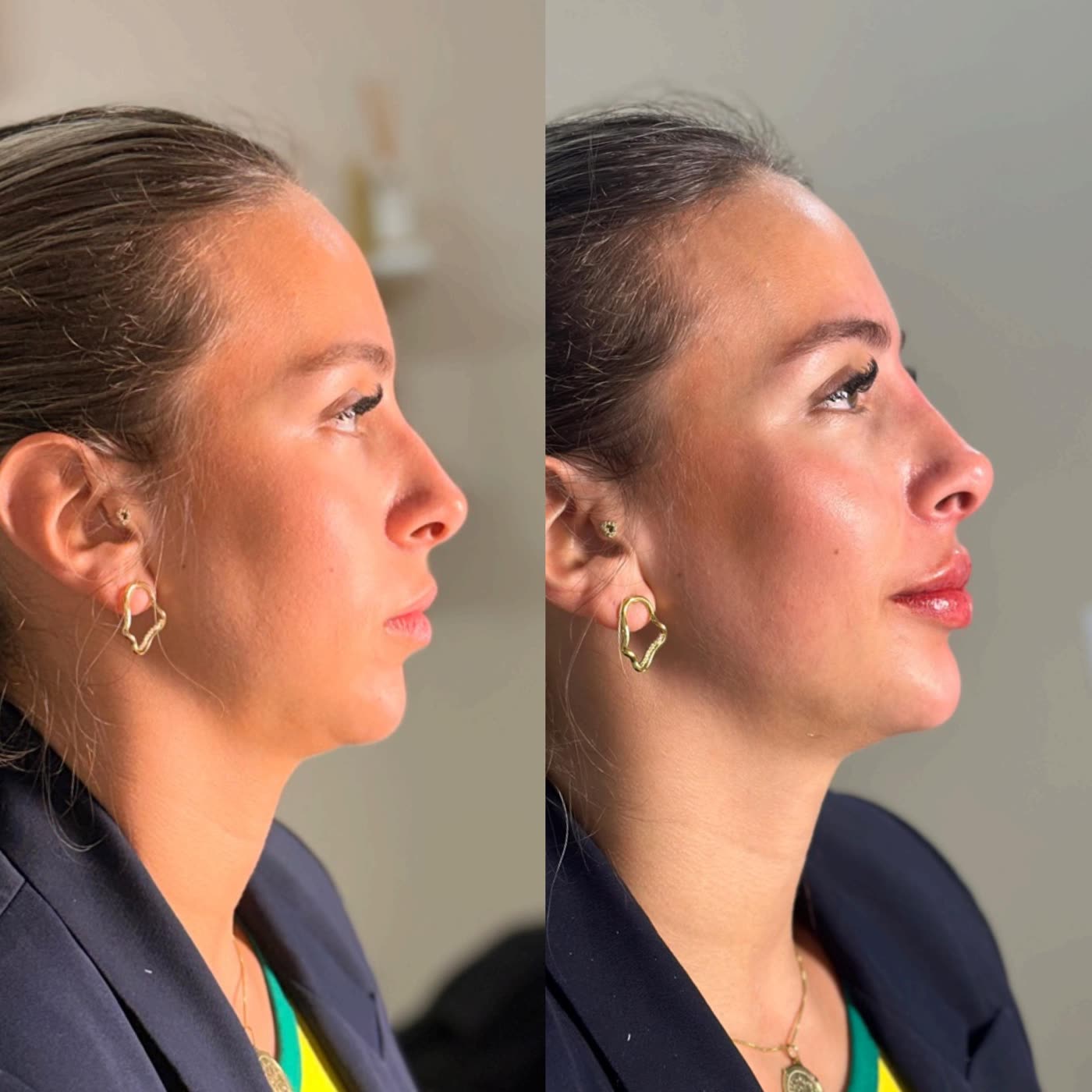 Resultado 12 de harmonização facial — antes e depois, perfil