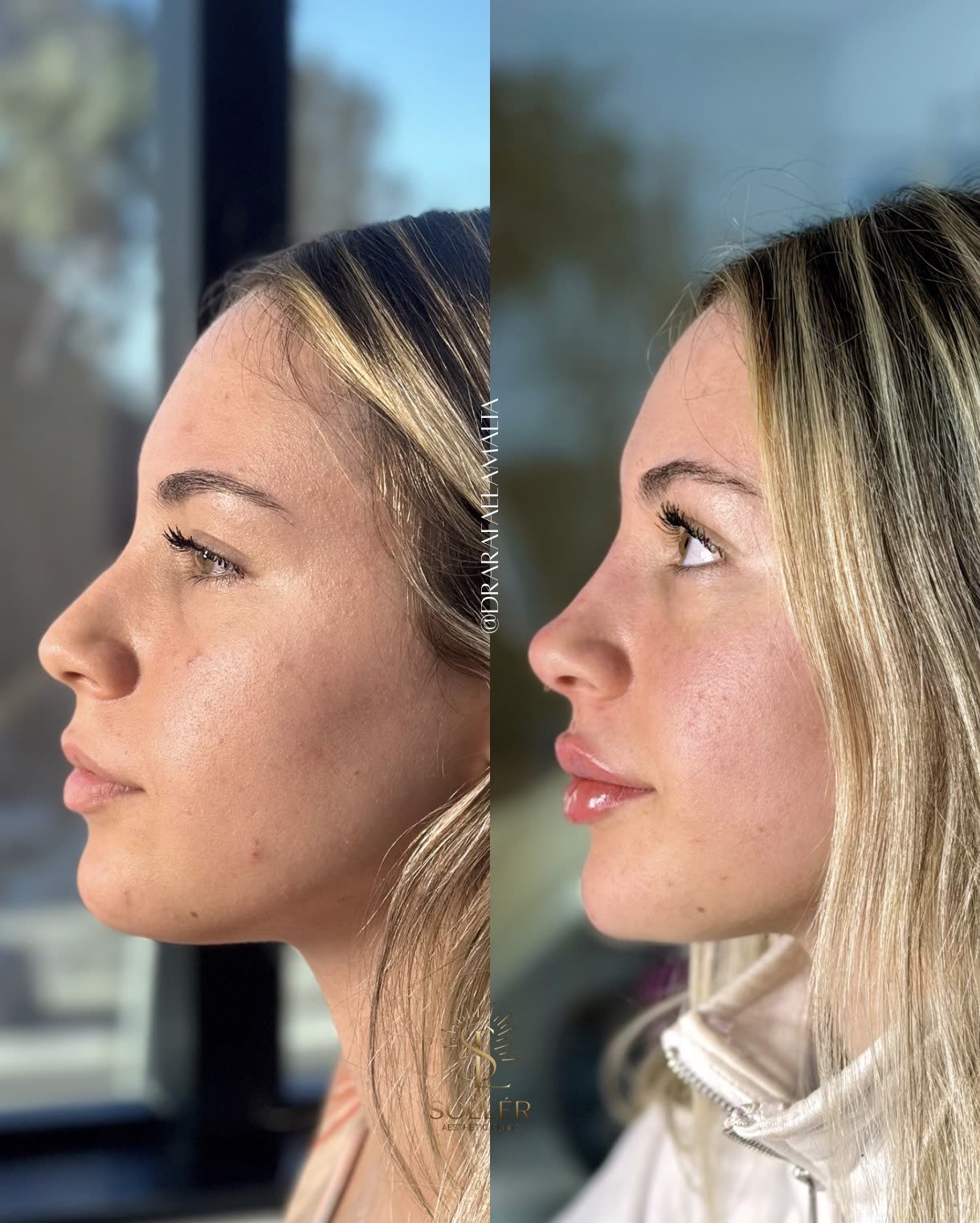 Resultado 13 de harmonização facial — antes e depois, perfil, queixo elevado