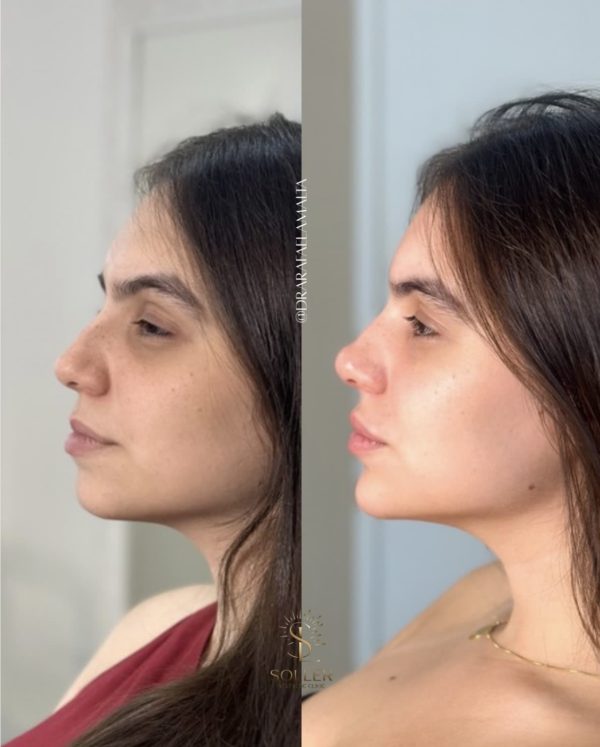 Resultado 14 de harmonização facial — antes e depois, perfil
