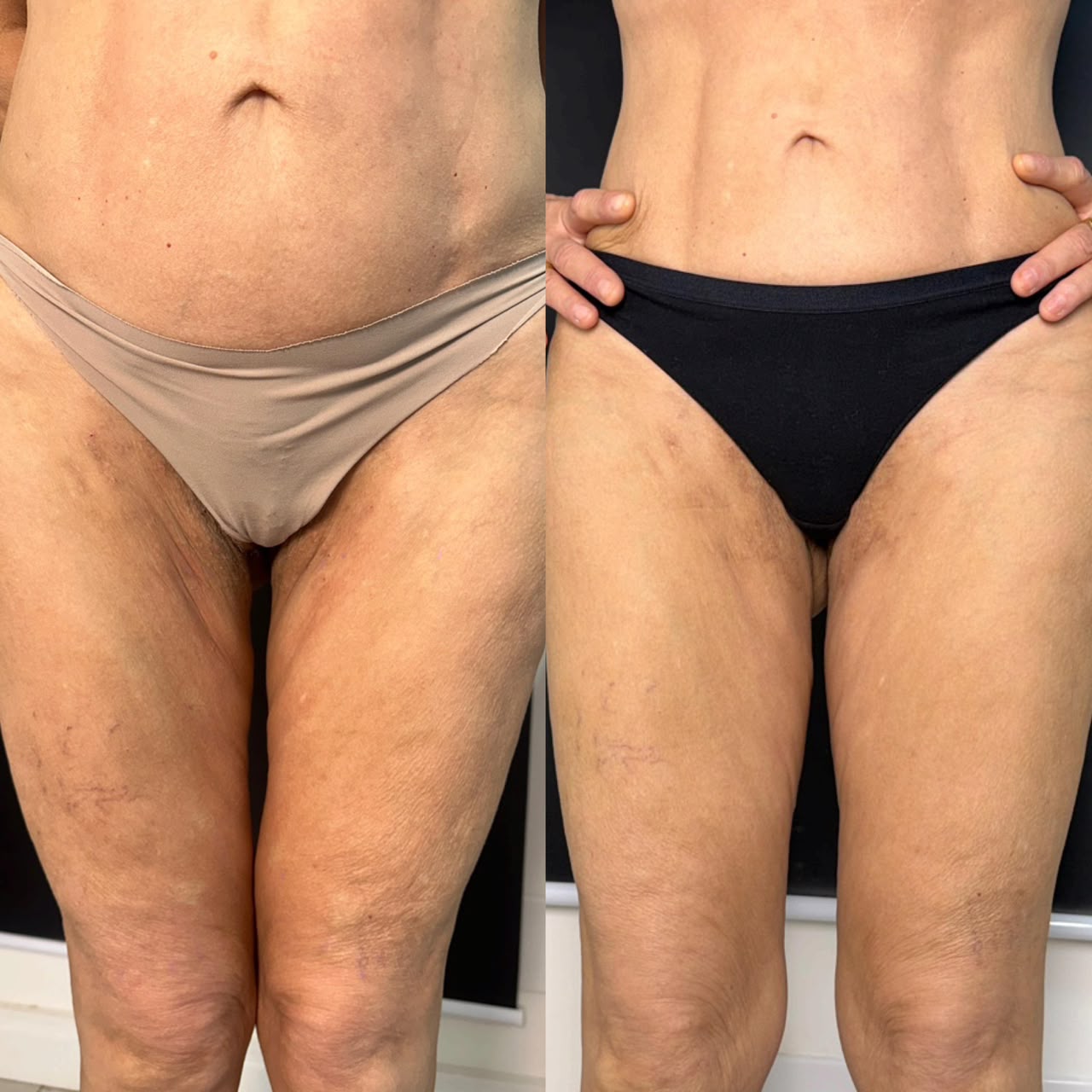 Resultado 15 de tratamento corporal — antes e depois, abdômen e coxas, vista frontal