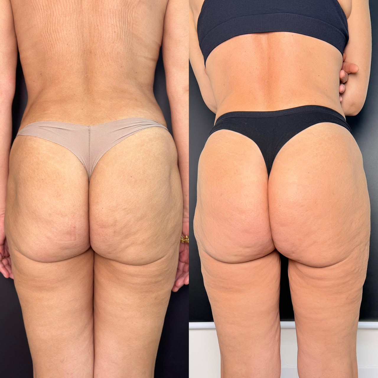 Resultado 16 de tratamento corporal — antes e depois, glúteos e costas, vista posterior