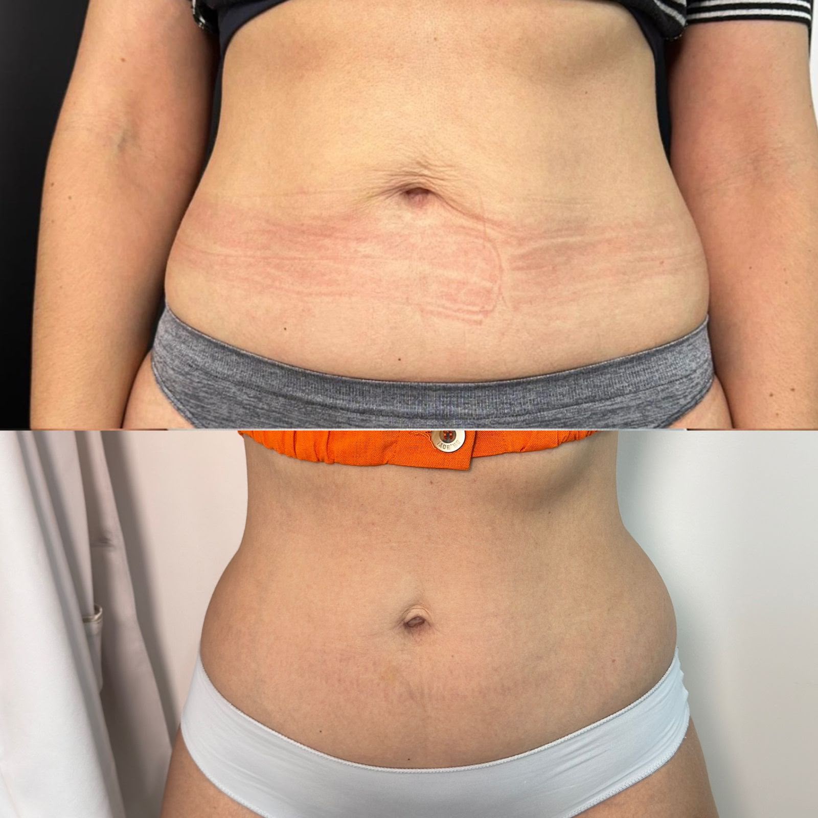 Resultado 17 de tratamento corporal — antes e depois, abdômen, vista frontal