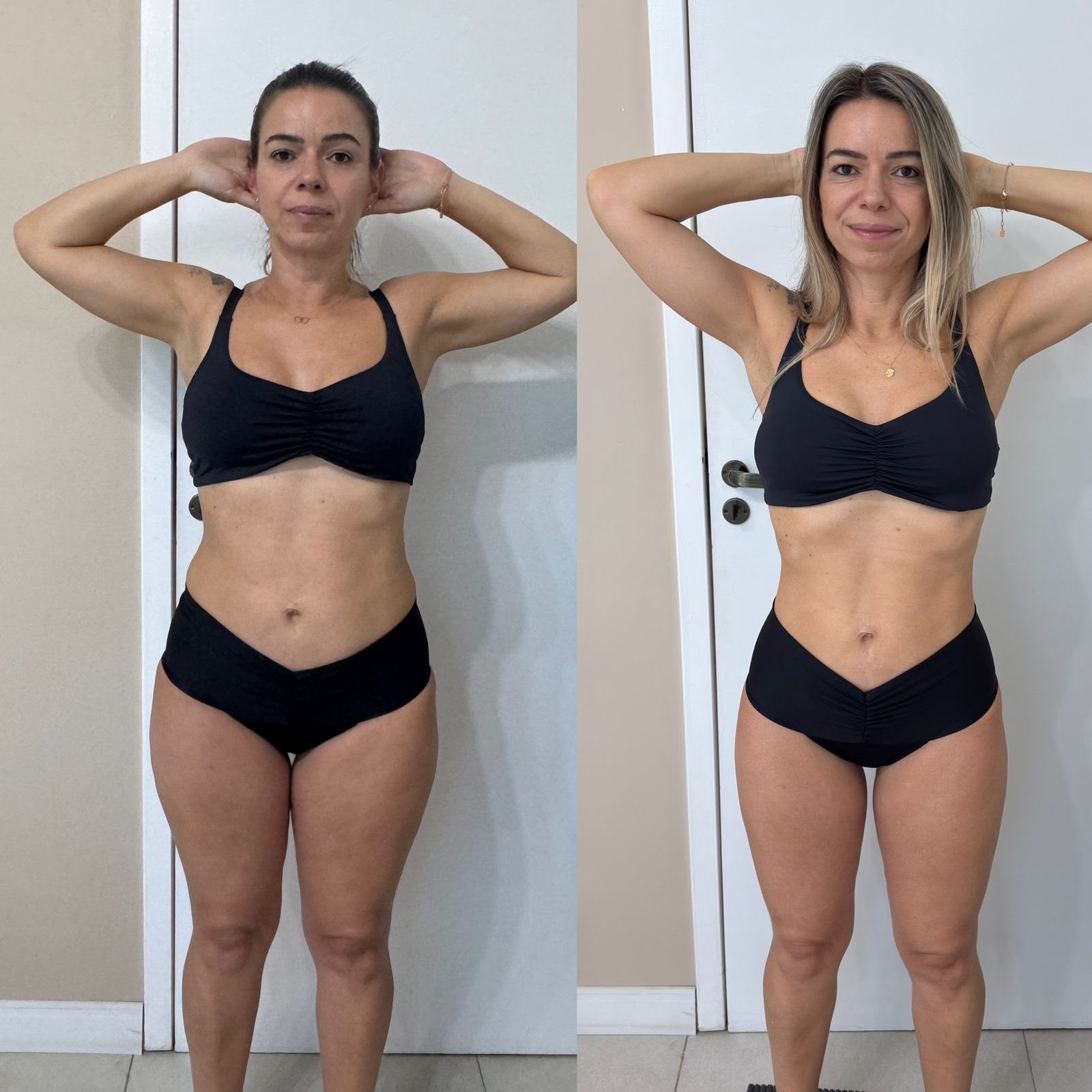 Resultado 18 de tratamento corporal — antes e depois, corpo inteiro, vista frontal